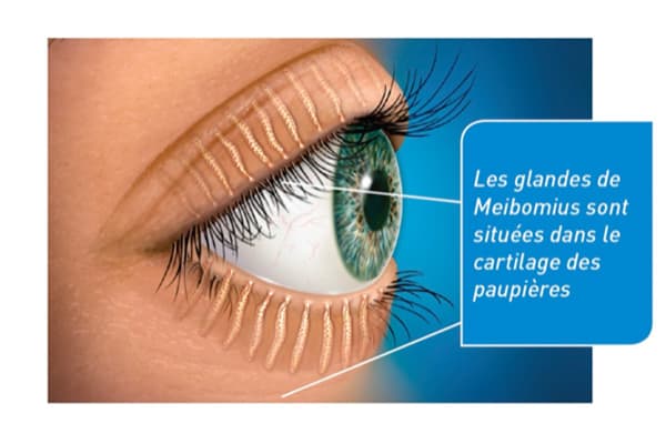 secheresse occulaire evaporative ou mixte clinique de la vision montpellier chirurgien ophtalmologue montpellier